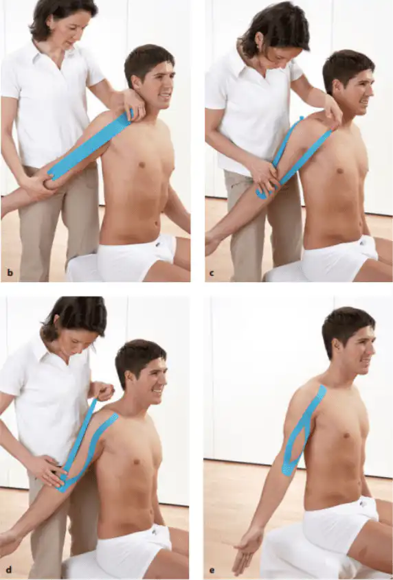 Тейпирование двуглавой мышцы плеча — Physiotherapist Тейпирование двуглавой мышцы плеча