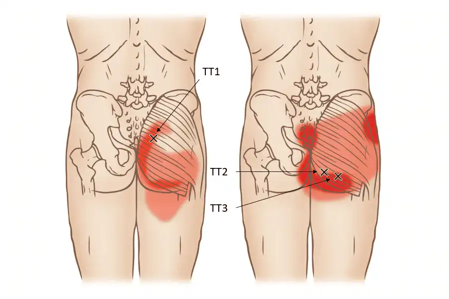 Триггерные точки большой ягодичной мышцы — Physiotherapist Триггерные точки большой ягодичной мышцы