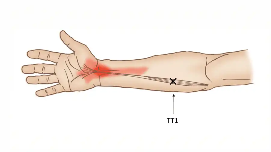 Триггерные точки длинной ладонной мышцы — Physiotherapist Триггерные точки длинной ладонной мышцы