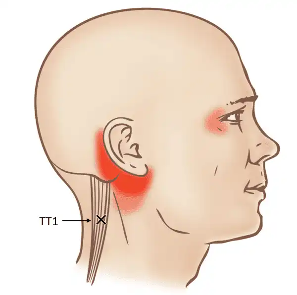 Триггерные точки длинной мышцы головы — Physiotherapist Триггерные точки длинной мышцы головы