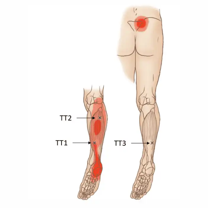 Триггерные точки камбаловидной мышцы — Physiotherapist Триггерные точки камбаловидной мышцы