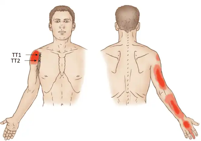 Триггерные точки клювовидно-плечевой мышцы — Physiotherapist Триггерные точки клювовидно-плечевой мышцы