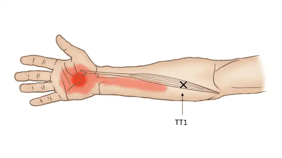 Триггерные точки лучевого сгибателя запястья — Physiotherapist Триггерные точки лучевого сгибателя запястья