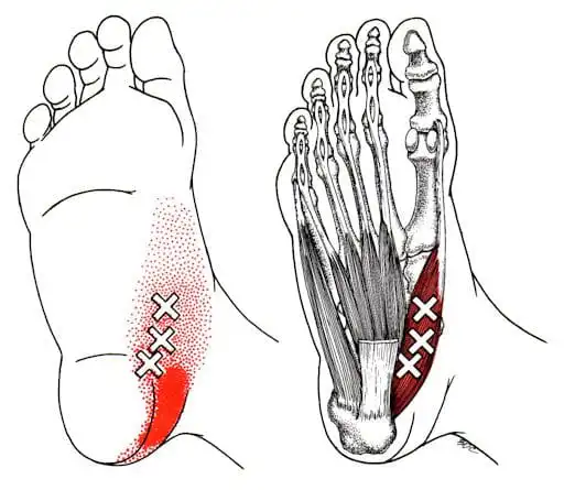 Триггерные точки мышцы, отводящей большой палец стопы — Physiotherapist Триггерные точки мышцы, отводящей большой палец стопы