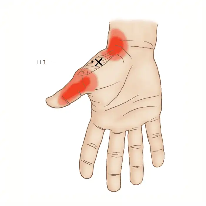 Триггерные точки мышцы, противопоставляющей большой палец — Physiotherapist Триггерные точки мышцы, противопоставляющей большой палец