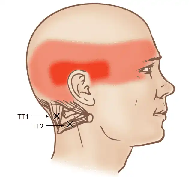 Триггерные точки подзатылочных мышц — Physiotherapist Триггерные точки подзатылочных мышц