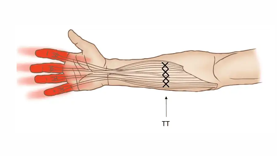Триггерные точки поверхностного сгибателя пальцев кисти — Physiotherapist Триггерные точки поверхностного сгибателя пальцев кисти