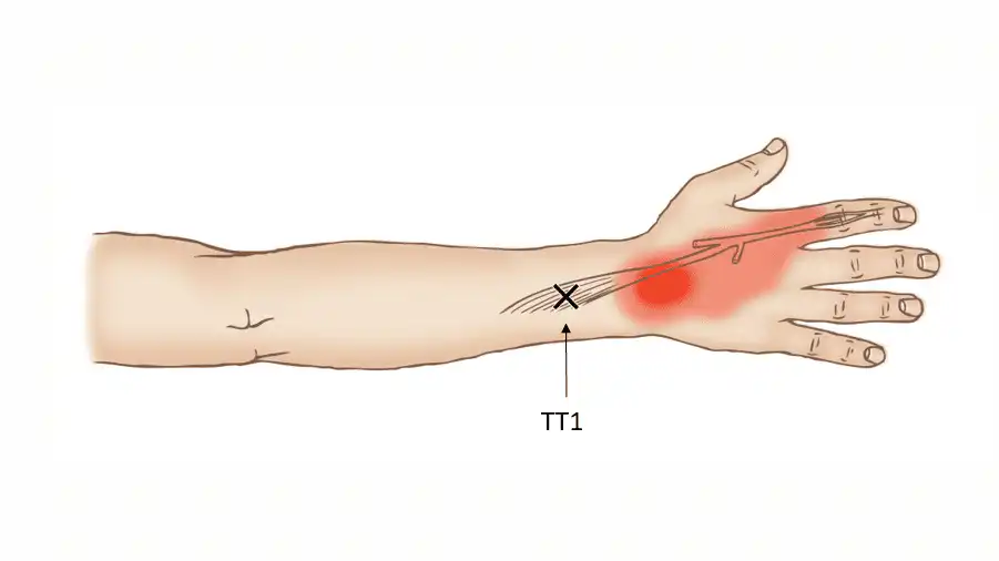 Триггерные точки собственного разгибателя указательного пальца — Physiotherapist Триггерные точки собственного разгибателя указательного пальца