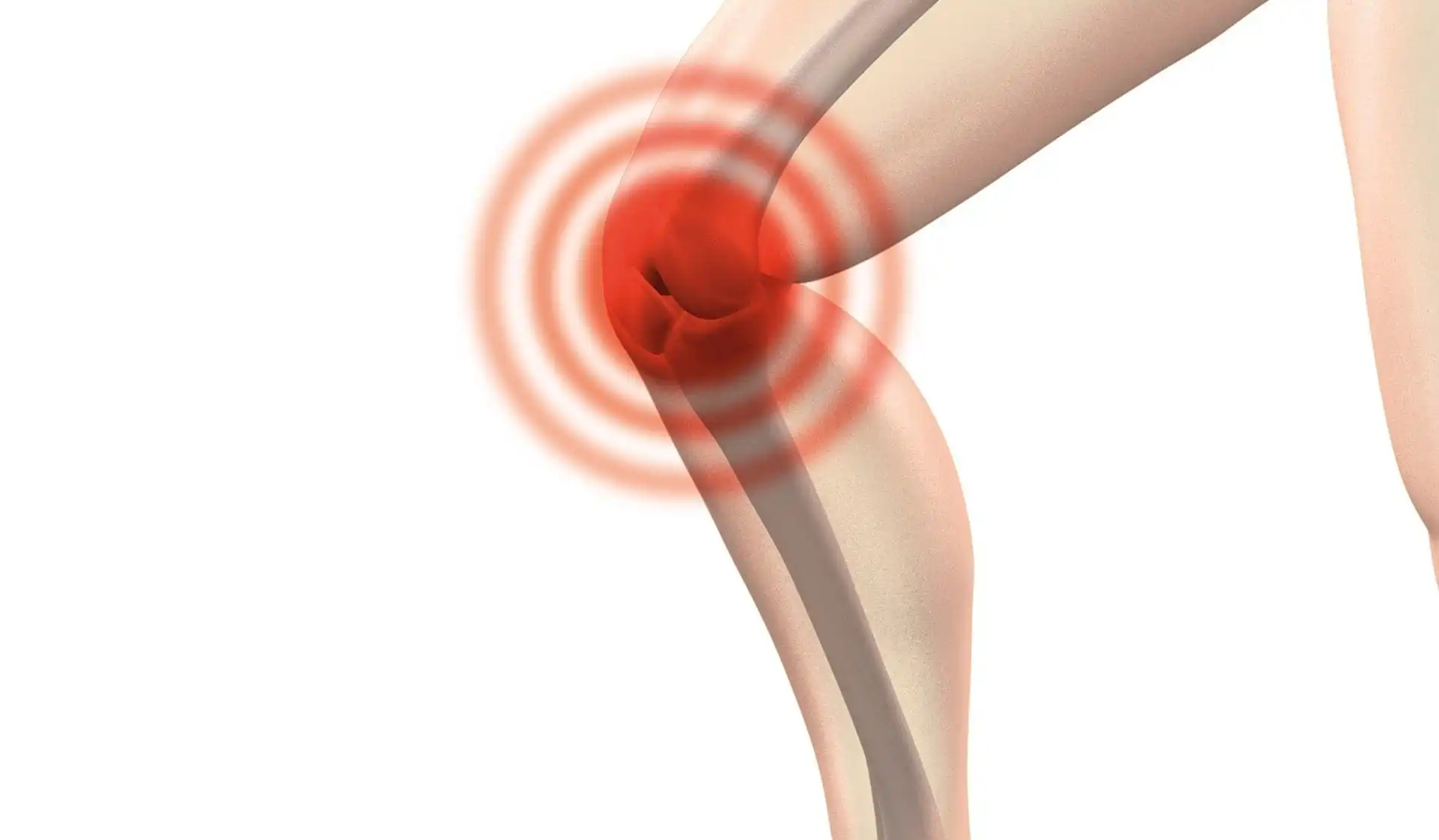 Пателлофеморальный синдром — Physiotherapist Пателлофеморальный синдром