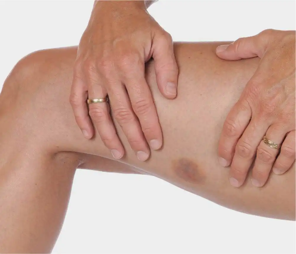 Ушиб четырехглавой мышцы — Physiotherapist Ушиб четырехглавой мышцы
