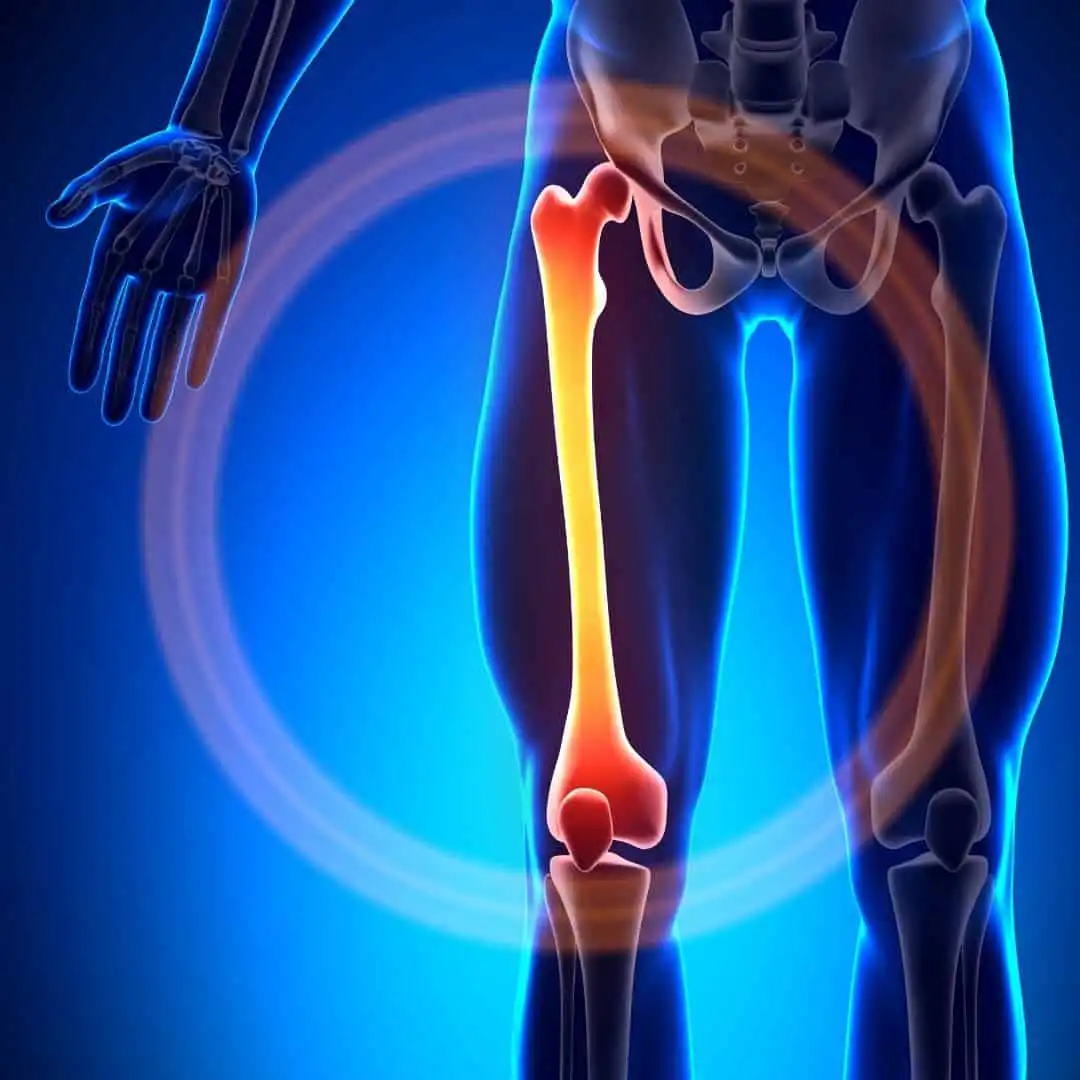 Перелом бедренной кости — Physiotherapist Перелом бедренной кости