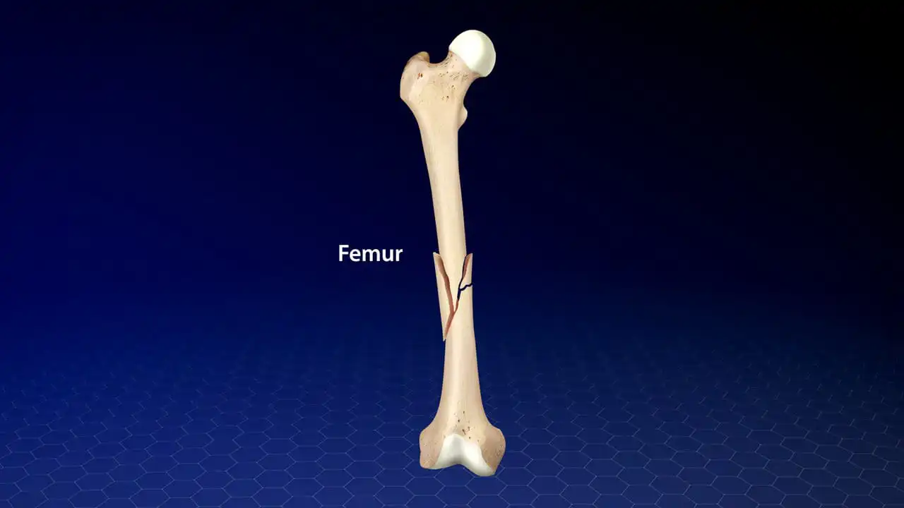 Перелом бедренной кости — Physiotherapist Перелом бедренной кости