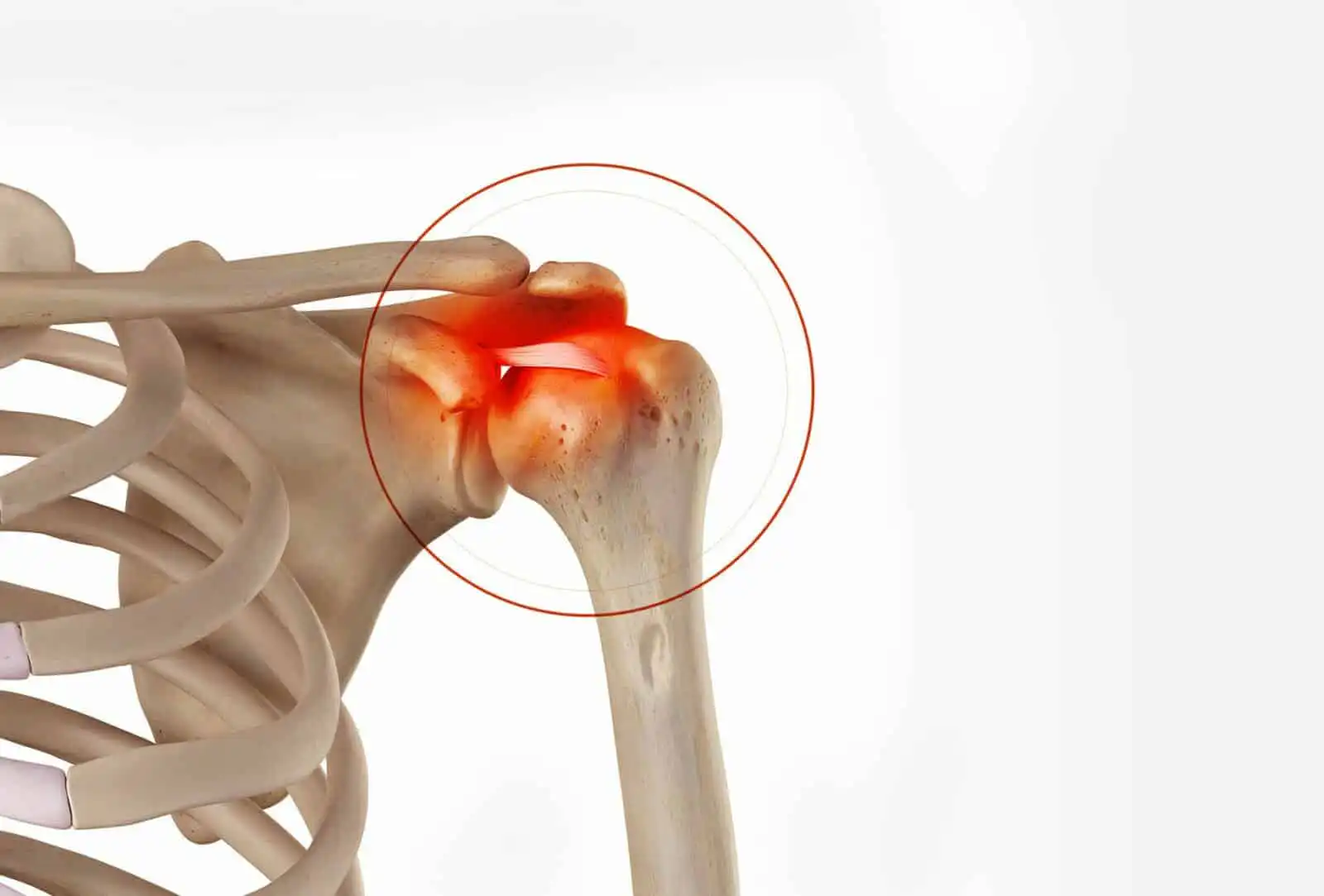 Кальцифицирующий тендинит плечевого сустава — Physiotherapist Кальцифицирующий тендинит плечевого сустава