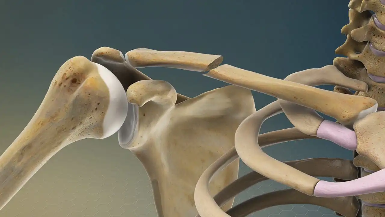 Перелом ключицы — Physiotherapist Перелом ключицы
