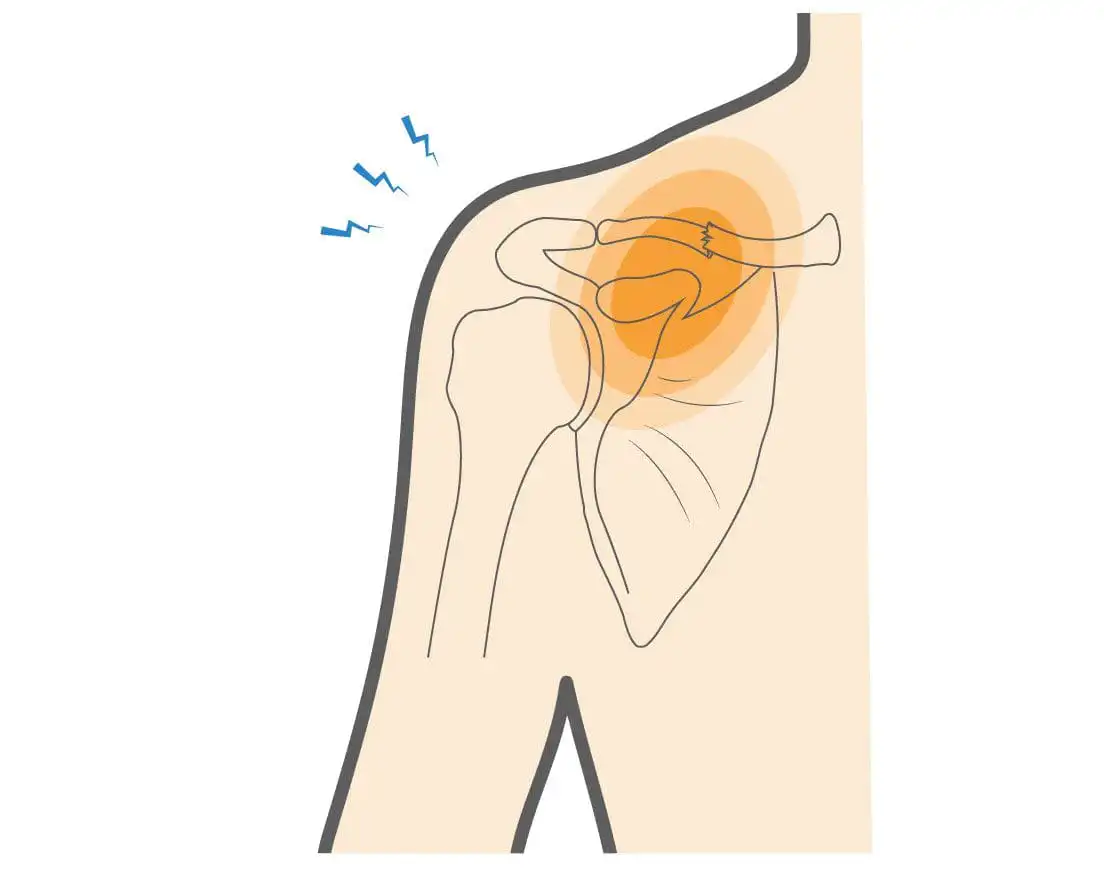 Перелом ключицы — Physiotherapist Перелом ключицы