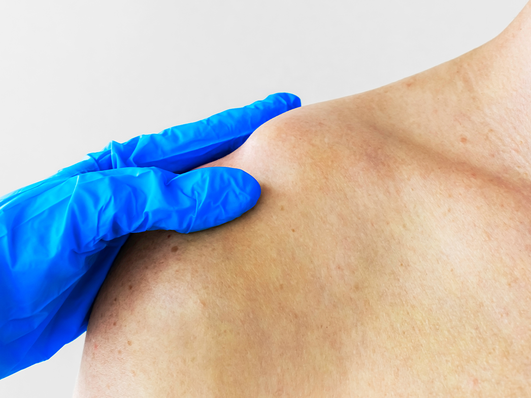 Перелом ключицы — Physiotherapist Перелом ключицы