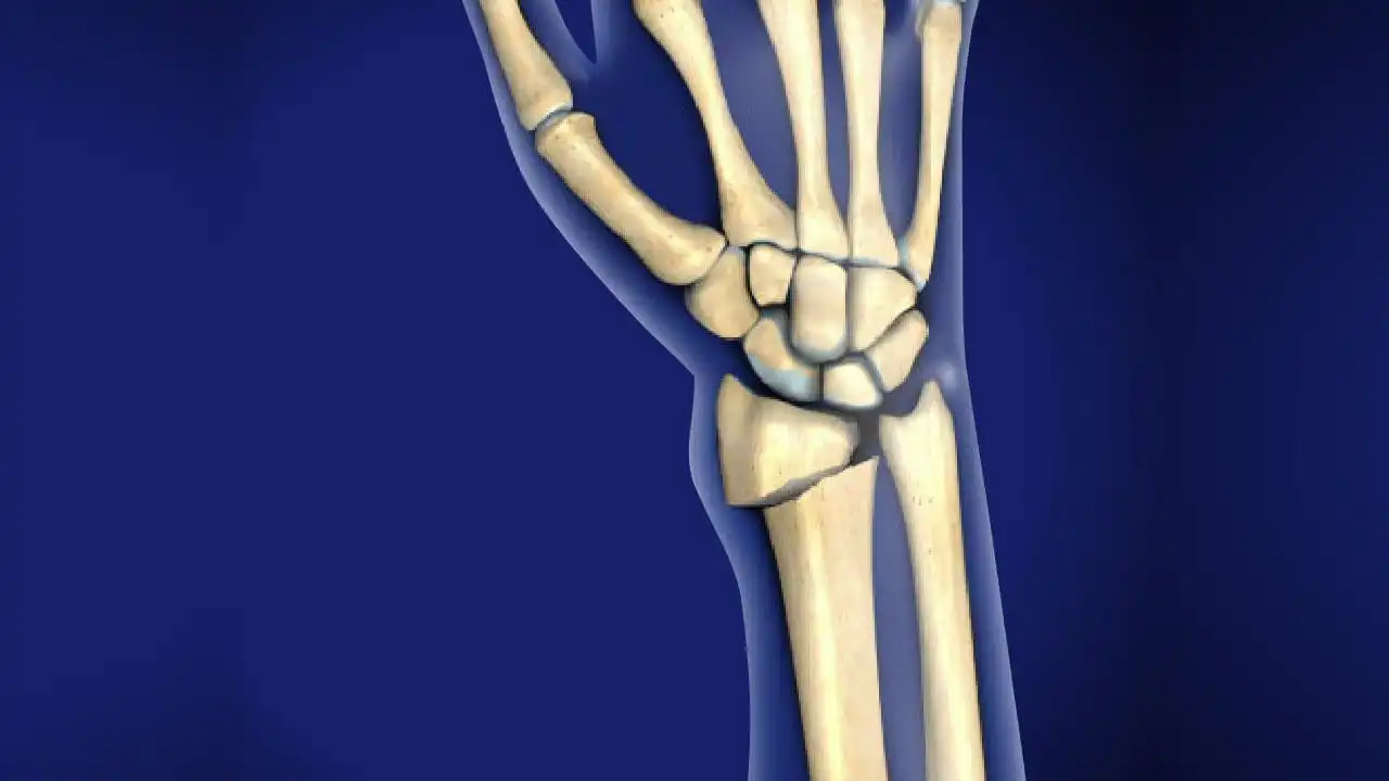 Перелом дистального отдела лучевой кости — Physiotherapist Перелом дистального отдела лучевой кости