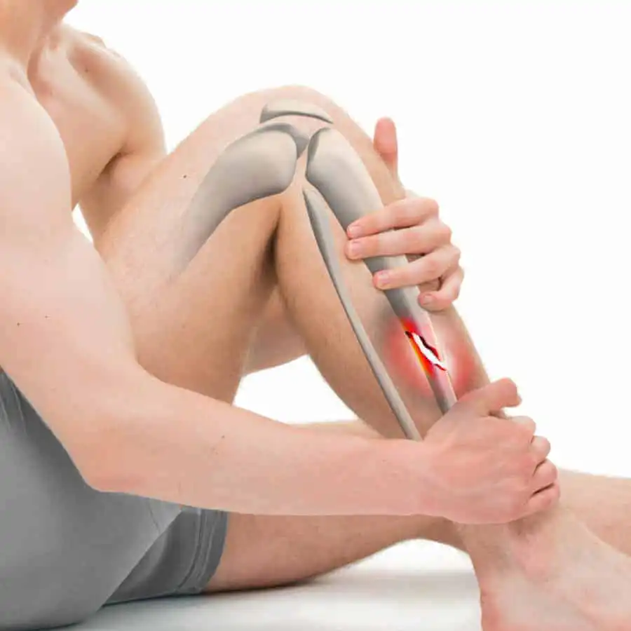 Перелом малоберцовой кости — Physiotherapist Перелом малоберцовой кости