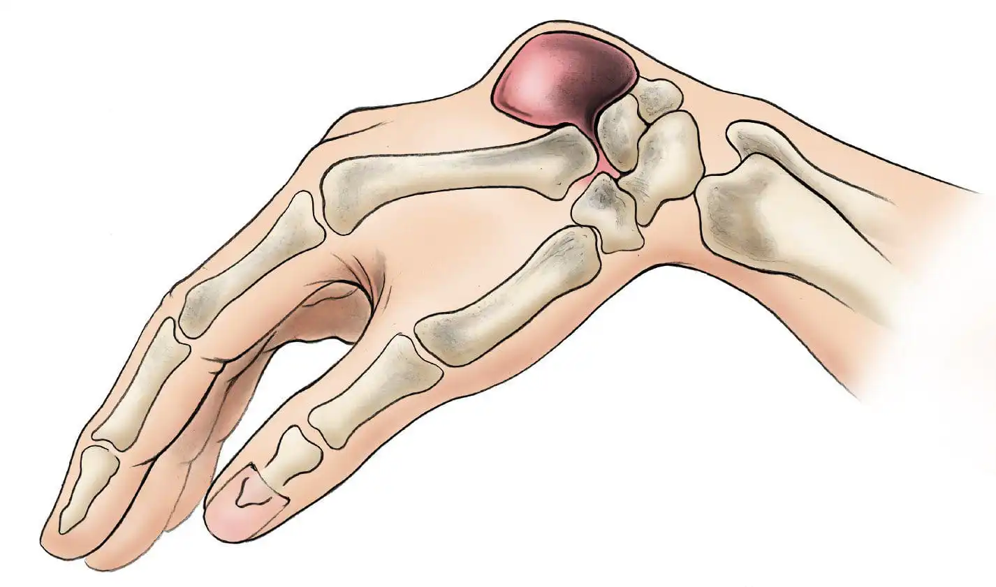 Ганглиевая киста — Physiotherapist Ганглиевая киста