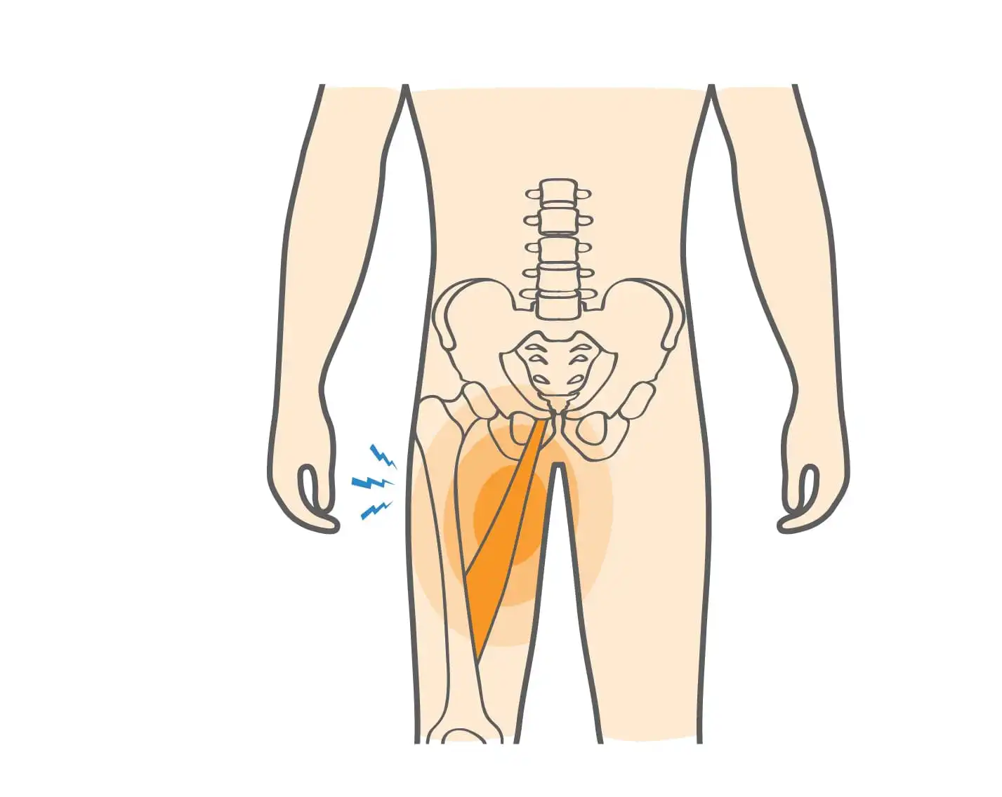 Растяжение паха — Physiotherapist Растяжение паха