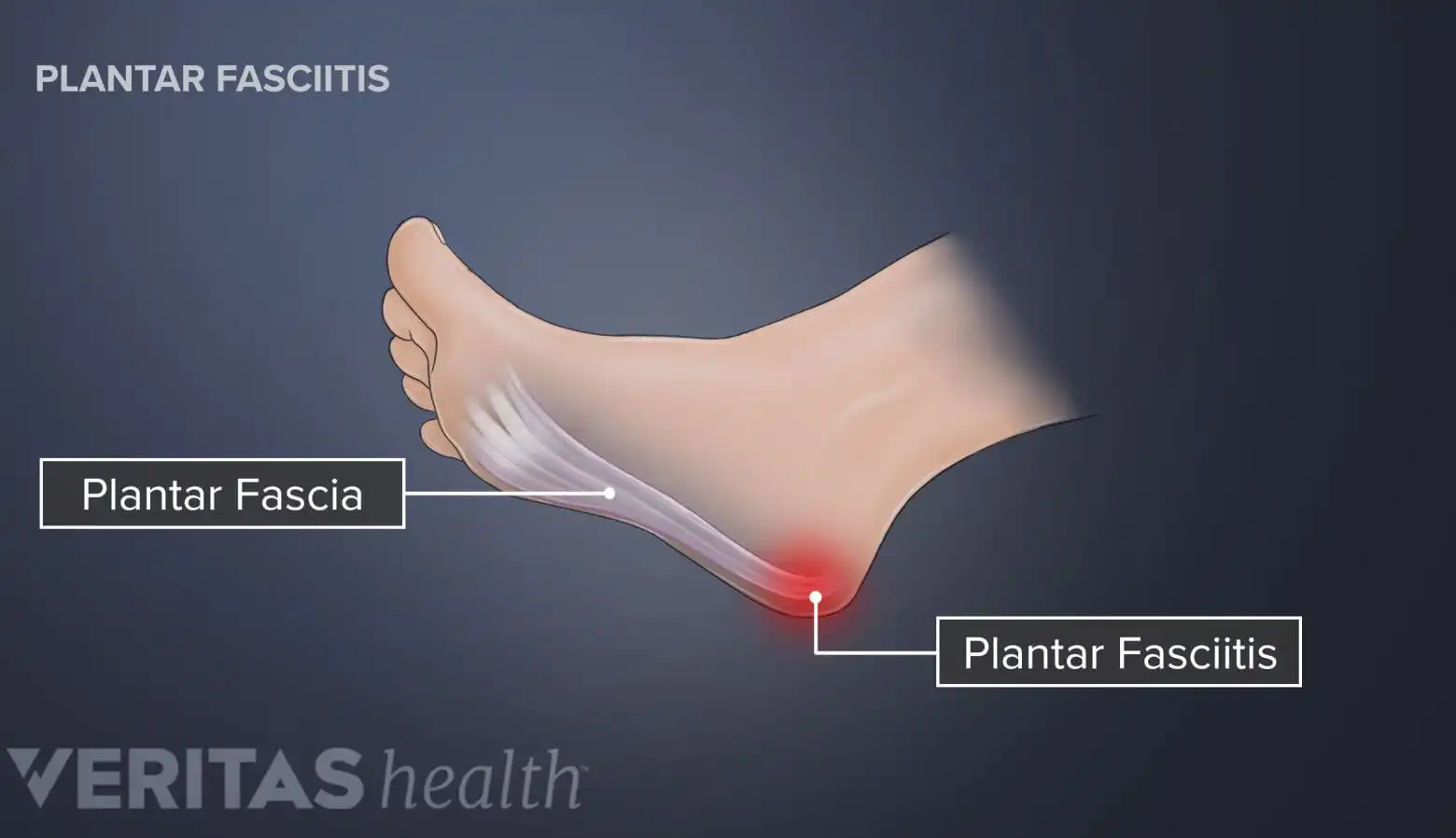 Плантарный фасциит — Physiotherapist Плантарный фасциит