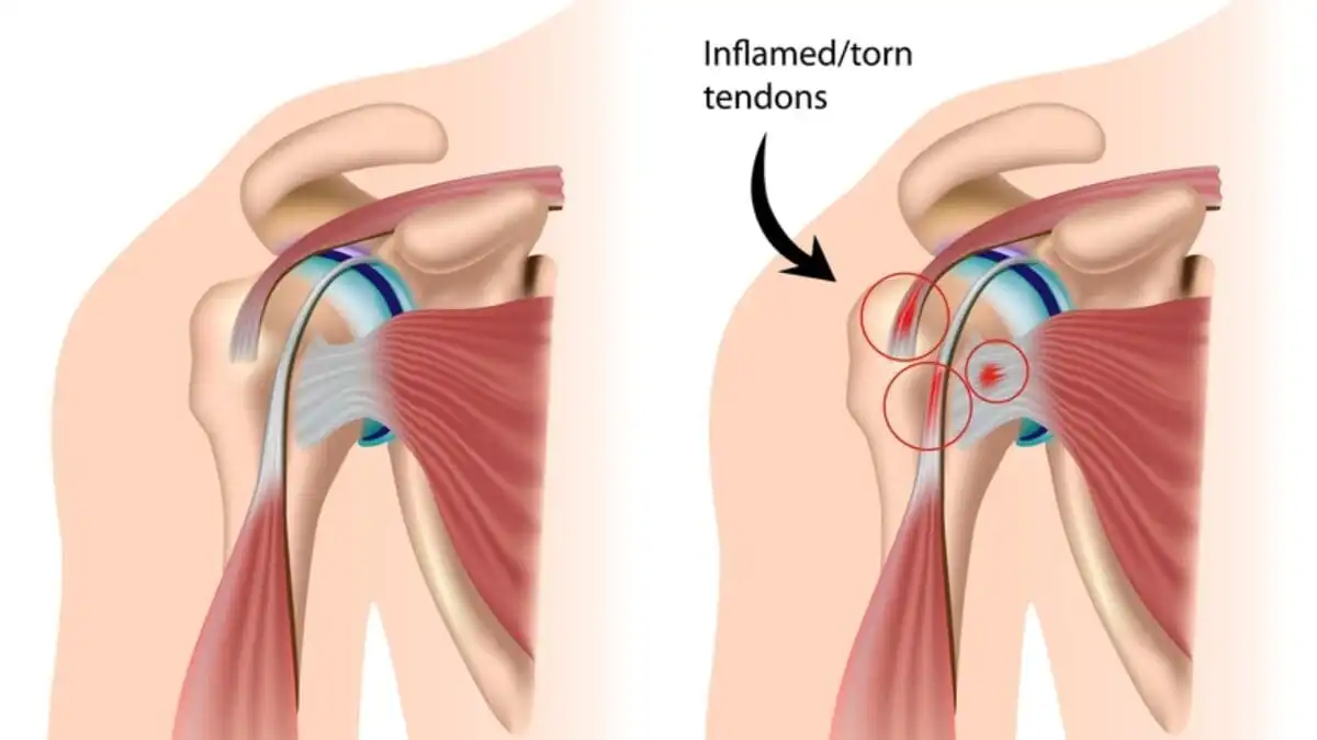 Тендинопатия ротаторной манжеты — Physiotherapist Тендинопатия ротаторной манжеты
