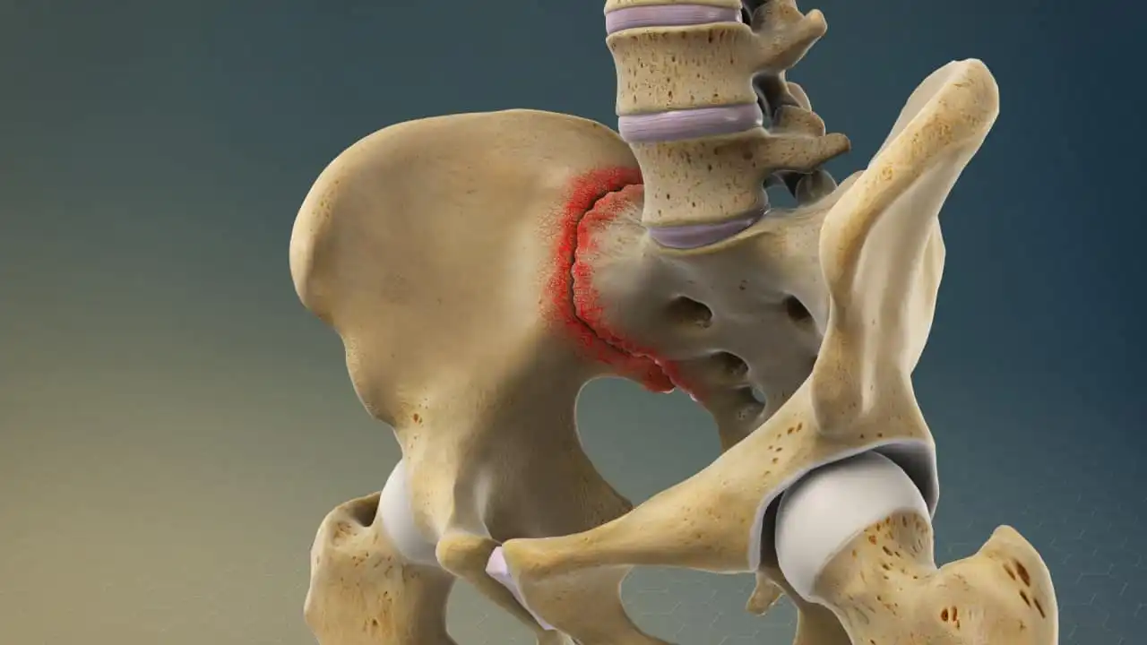 Синдром крестцово-подвздошного сочленения — Physiotherapist Синдром крестцово-подвздошного сочленения
