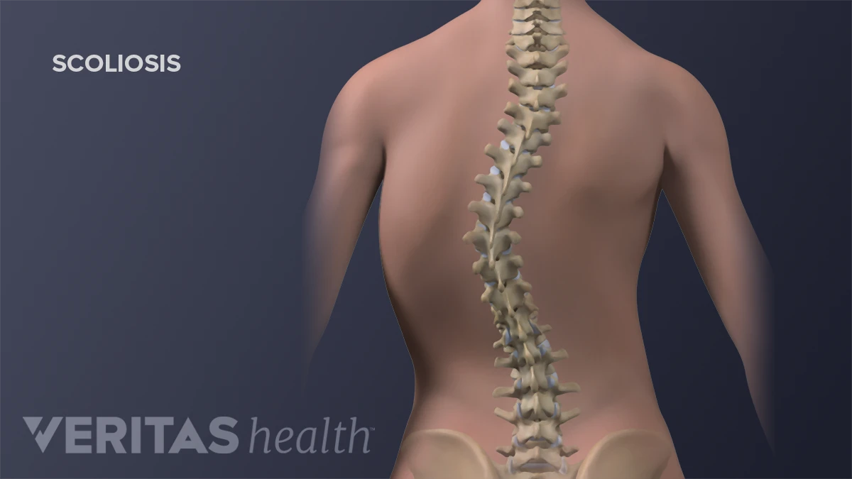 Сколиоз — Physiotherapist Сколиоз