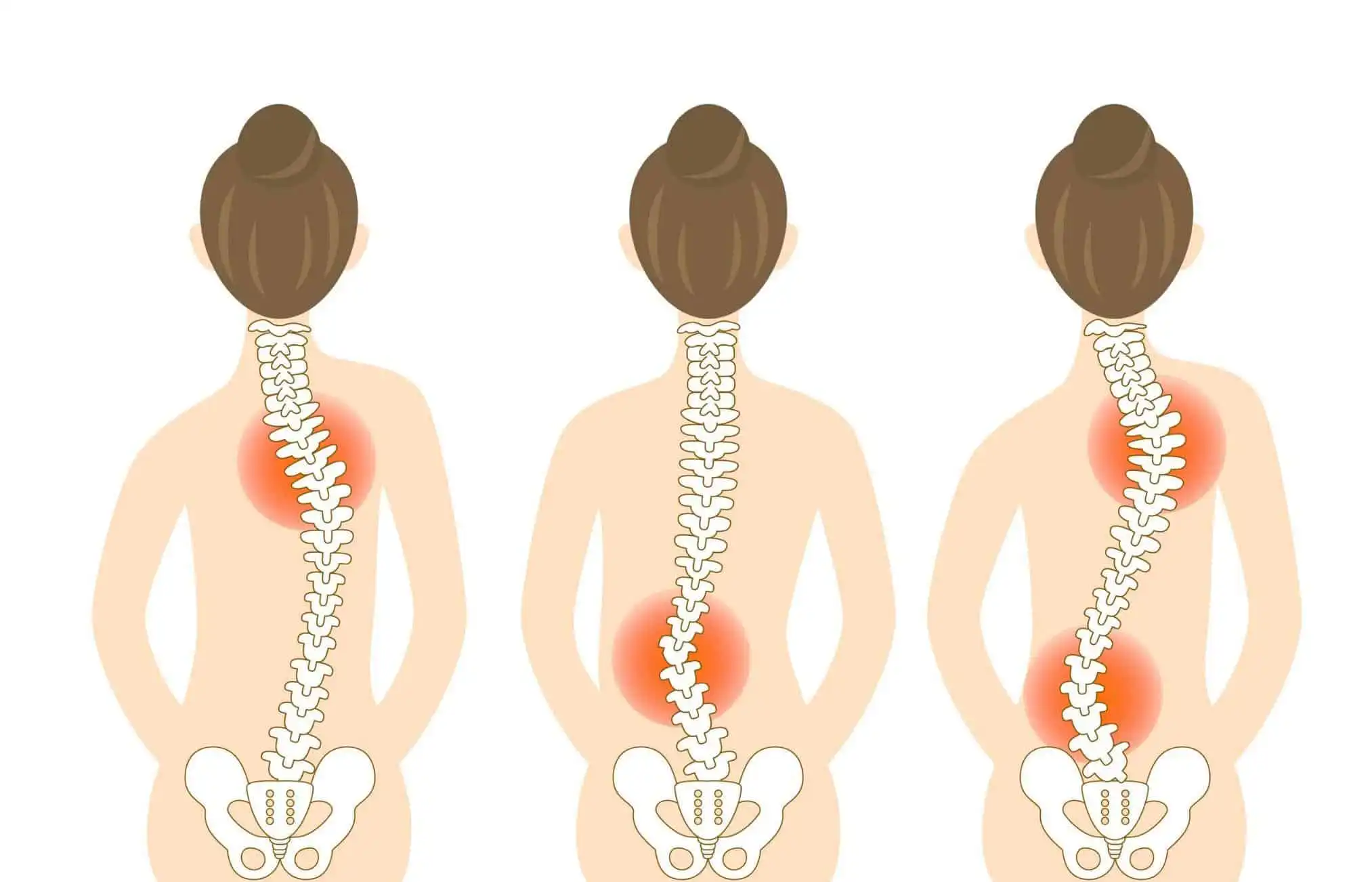 Сколиоз — Physiotherapist Сколиоз