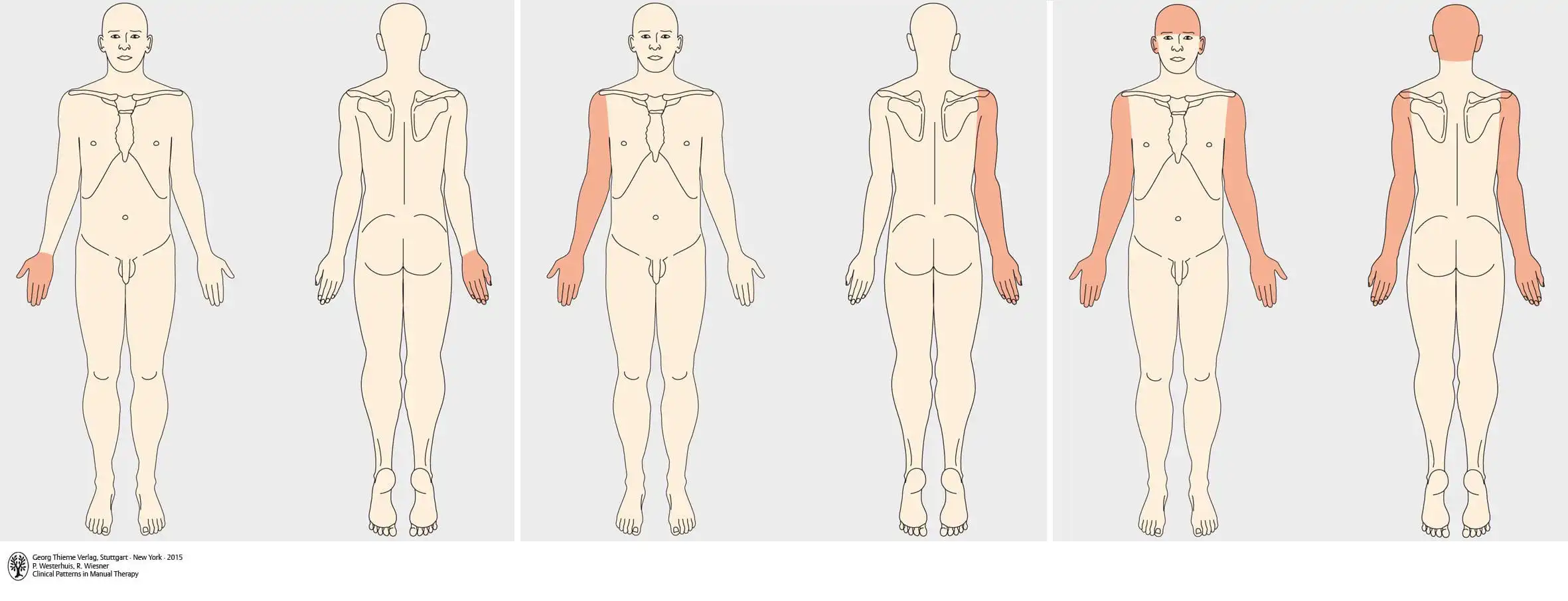 Синдром Т4 — Physiotherapist Синдром Т4