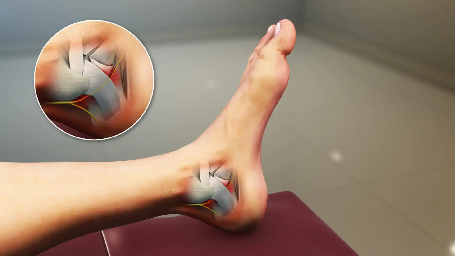 Синдром тарзального канала — Physiotherapist Синдром тарзального канала