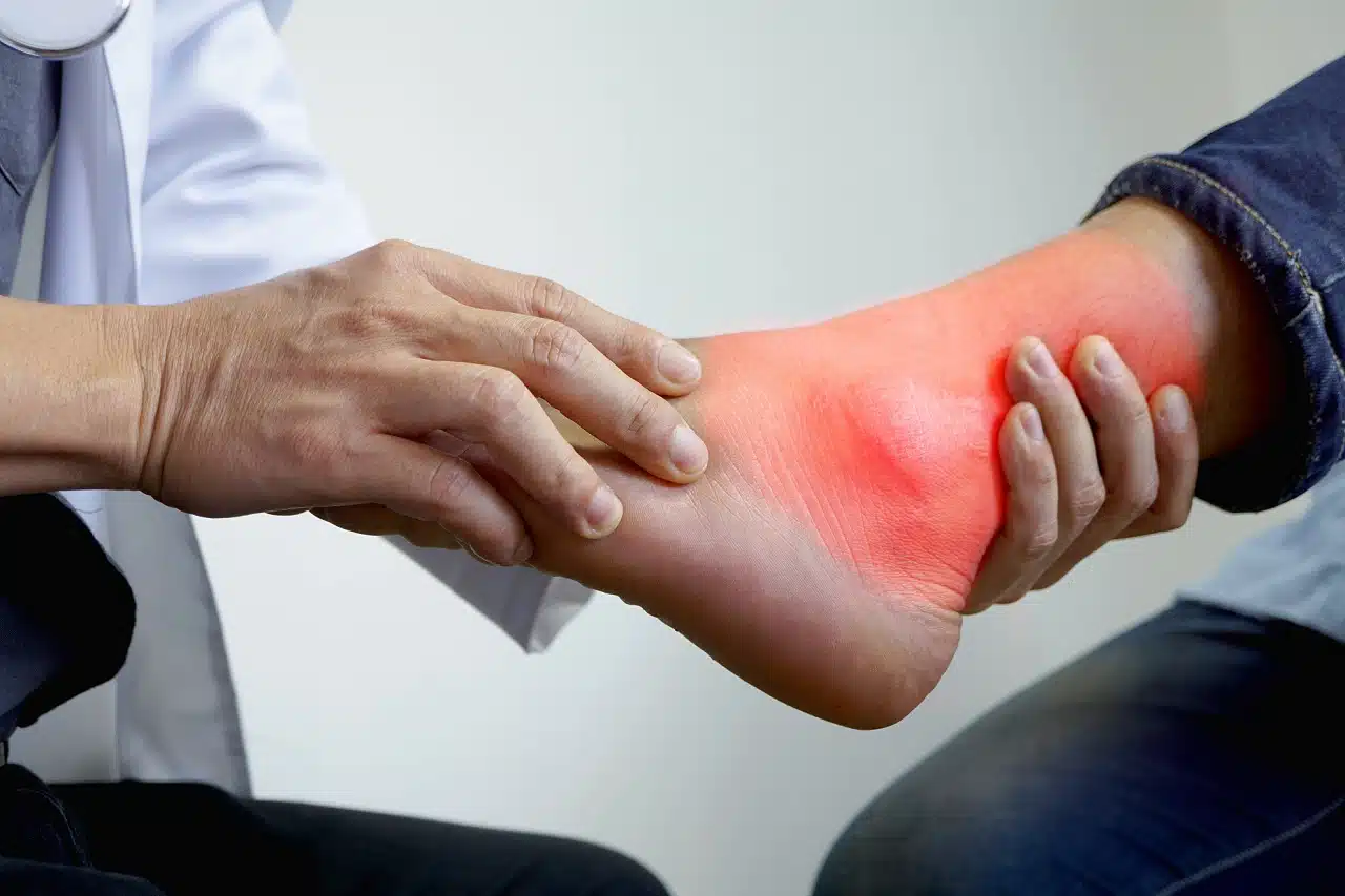 Синдром тарзального канала — Physiotherapist Синдром тарзального канала
