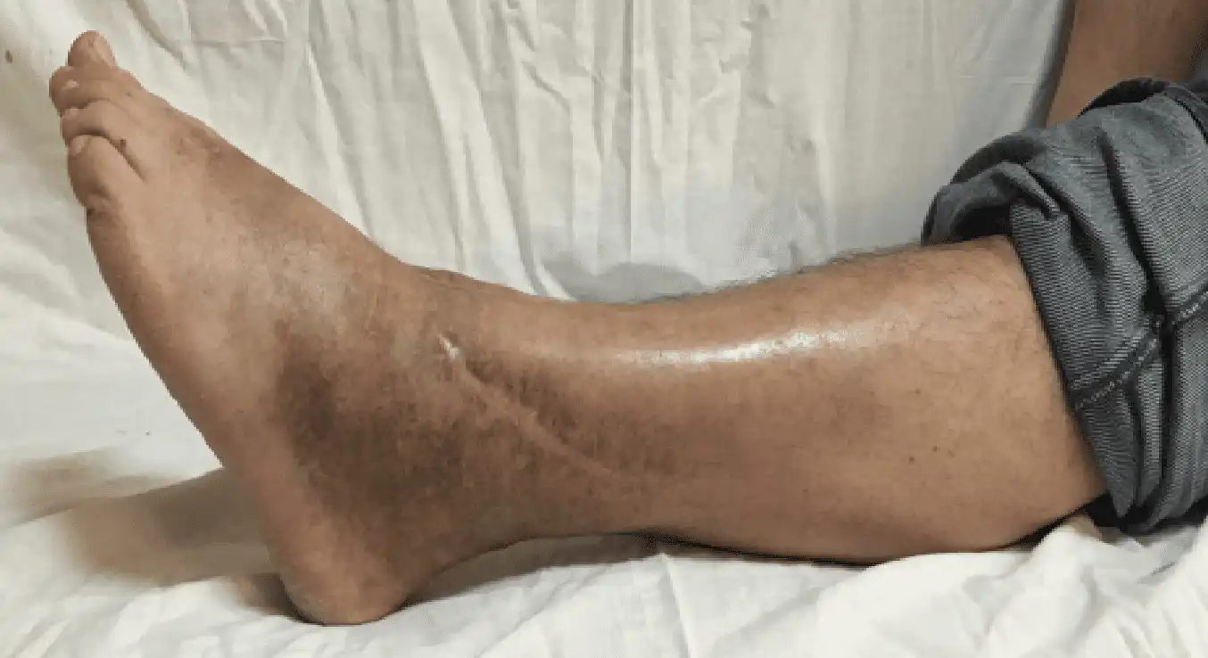 Эндопротезирование голеностопного сустава — Physiotherapist Эндопротезирование голеностопного сустава