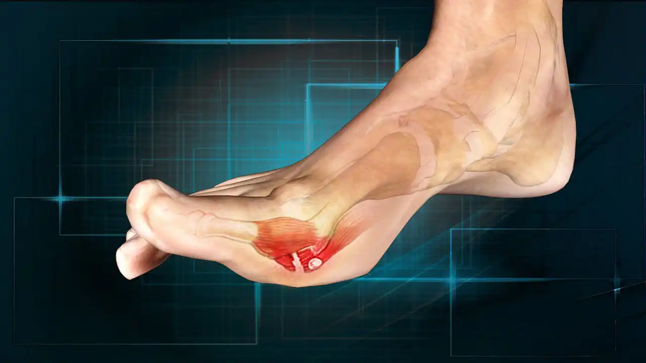 Торфяной палец — Physiotherapist Торфяной палец
