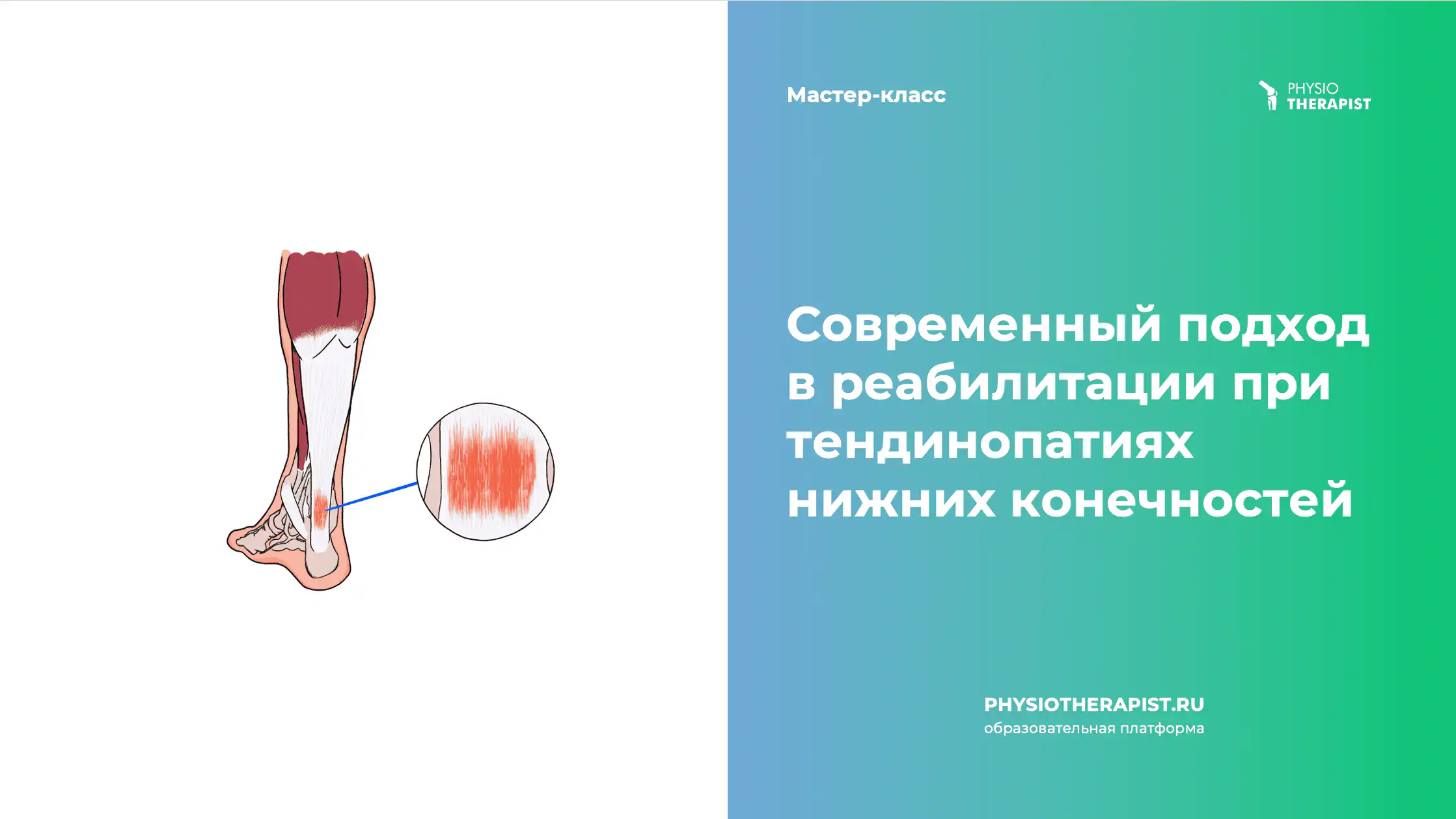 Современный подход в реабилитации при тендинопатиях нижних конечностей