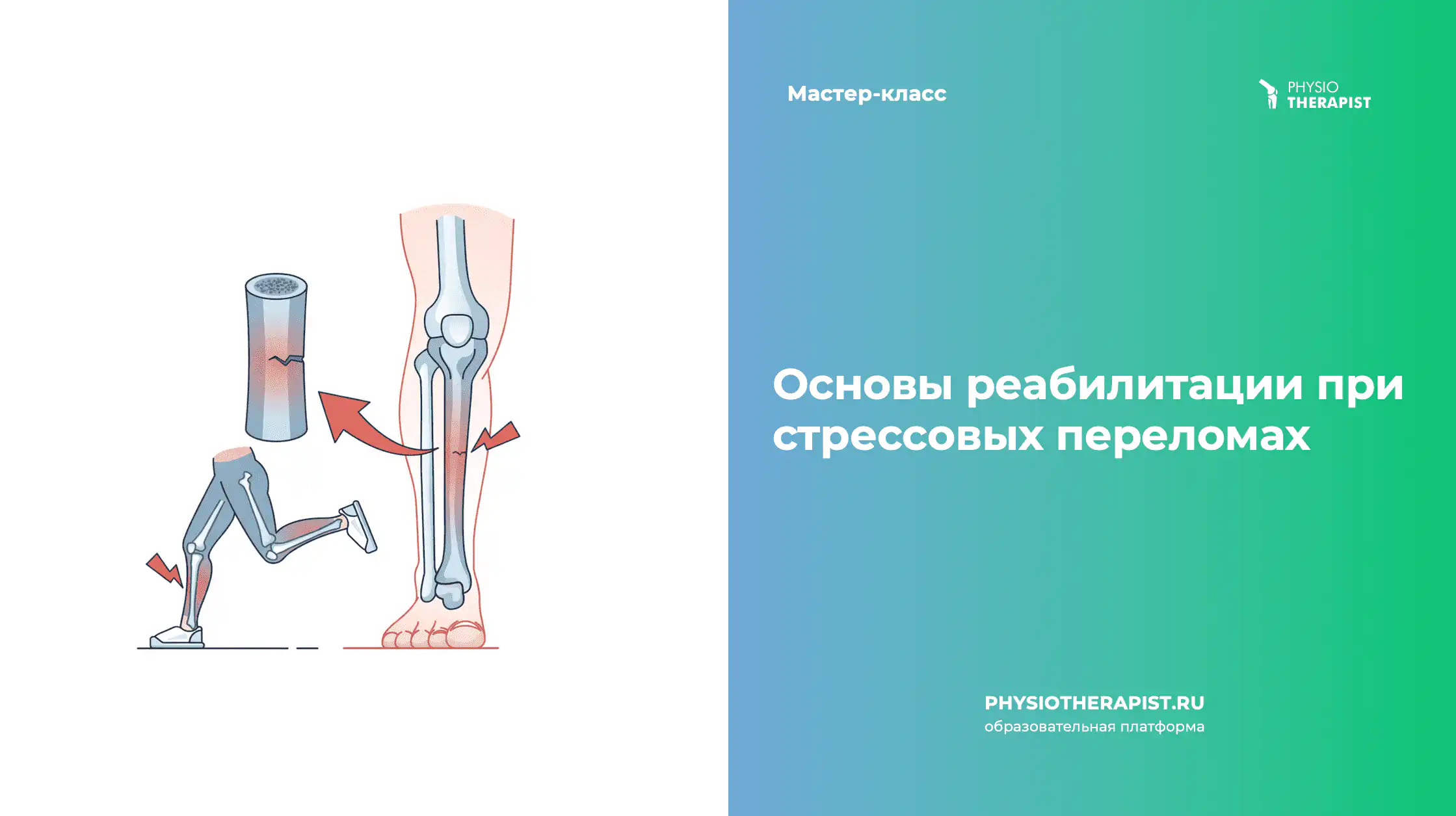 Основы реабилитации при стрессовых переломах